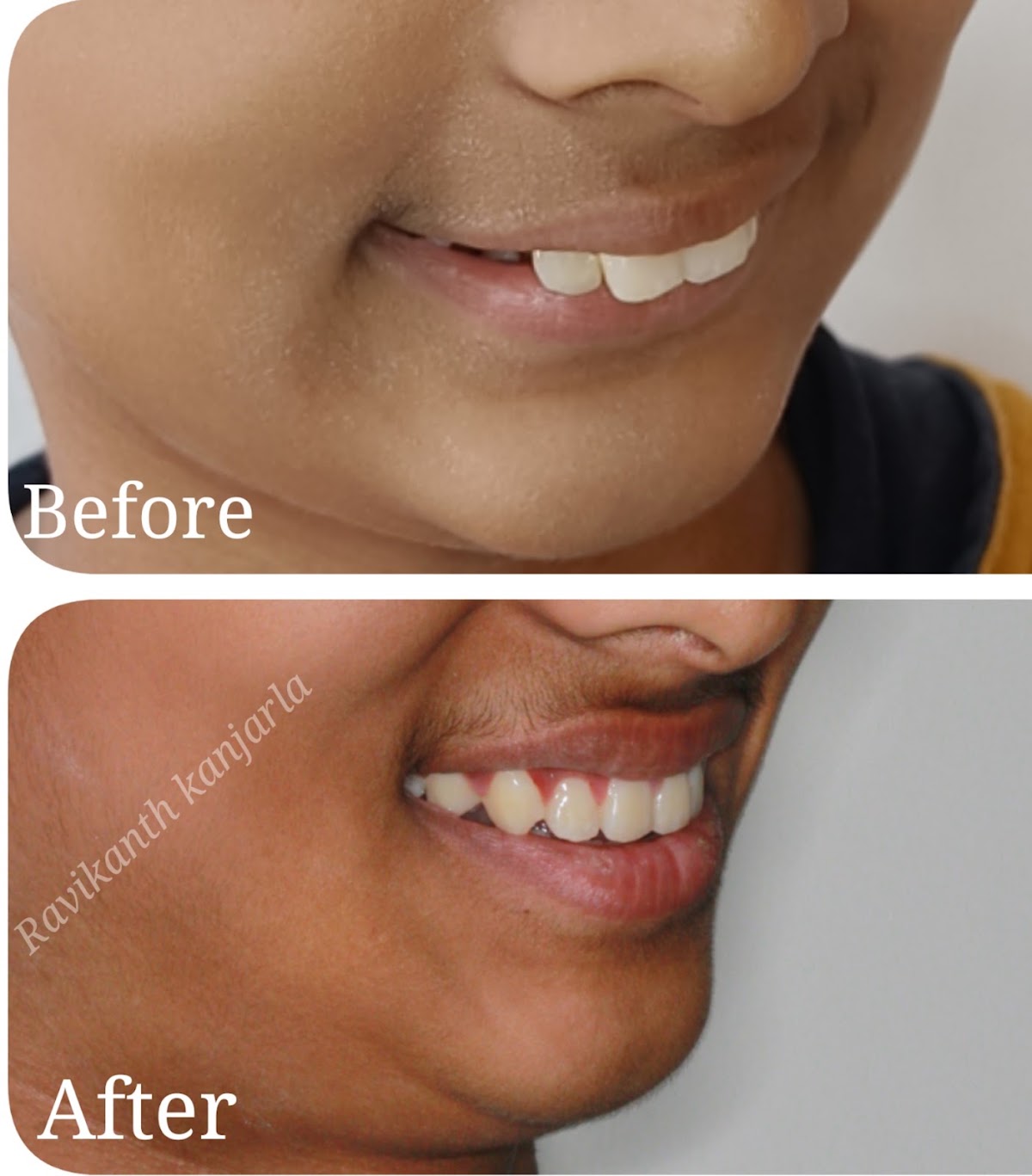 Dr.Ravi's Dental & Orthodontic centre, Invisalign provider